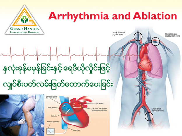 Arrhythmia and Ablation