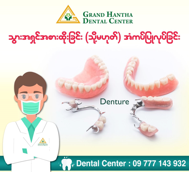 သွားအရှင်အစားထိုးခြင်း (သို့မဟုတ်) အံကပ် ပြုလုပ်ခြင်း ( Removable Denture )